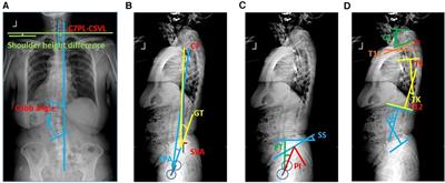 Correlation analysis of surgical outcomes and spino-pelvic parameters in patients with degenerative lumbar scoliosis